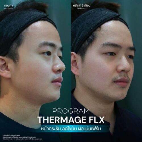 โปรแกรม Thermage FLX คืออะไรและมีหลักการทำงานอย่างไร เพื่อยกกระชับผิวหน้า 8 BA Thermage 09