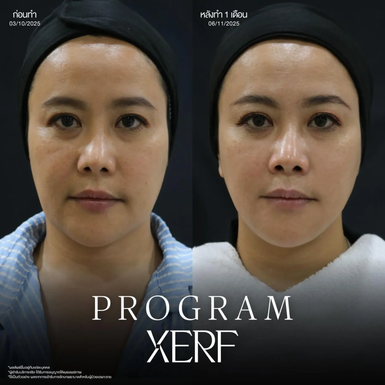 โปรแกรม XERF หัตถการยกกระชับล่าสุด เหมาะกับใคร แตกต่างจากเครื่องอื่นยังไง? 4 ขั้นตอน XERF