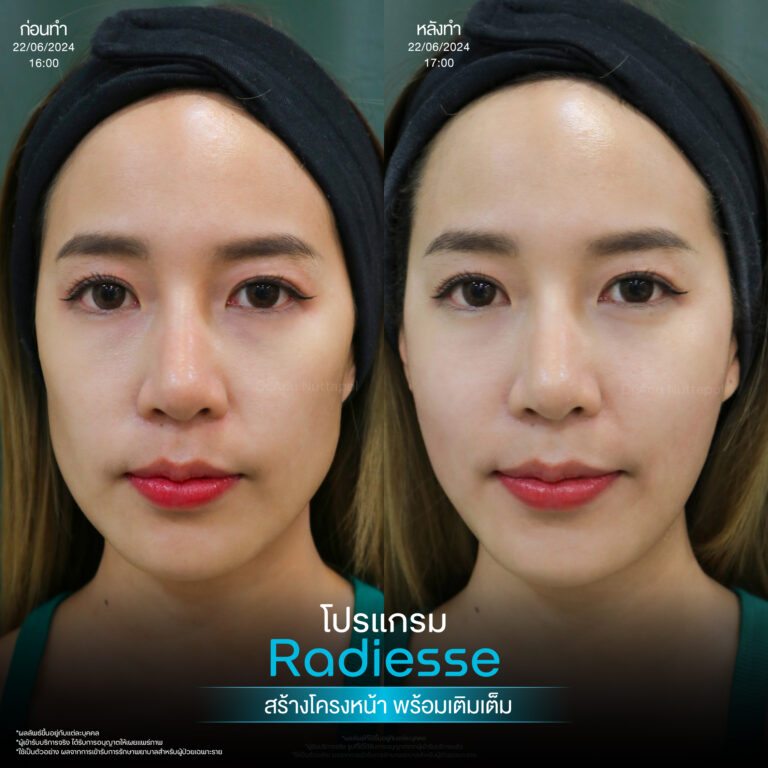 เติมเต็มผิวอิ่มฟูด้วยโปรแกรม Regenerative Radiesse Filler 2 BA Radiesse 01 1