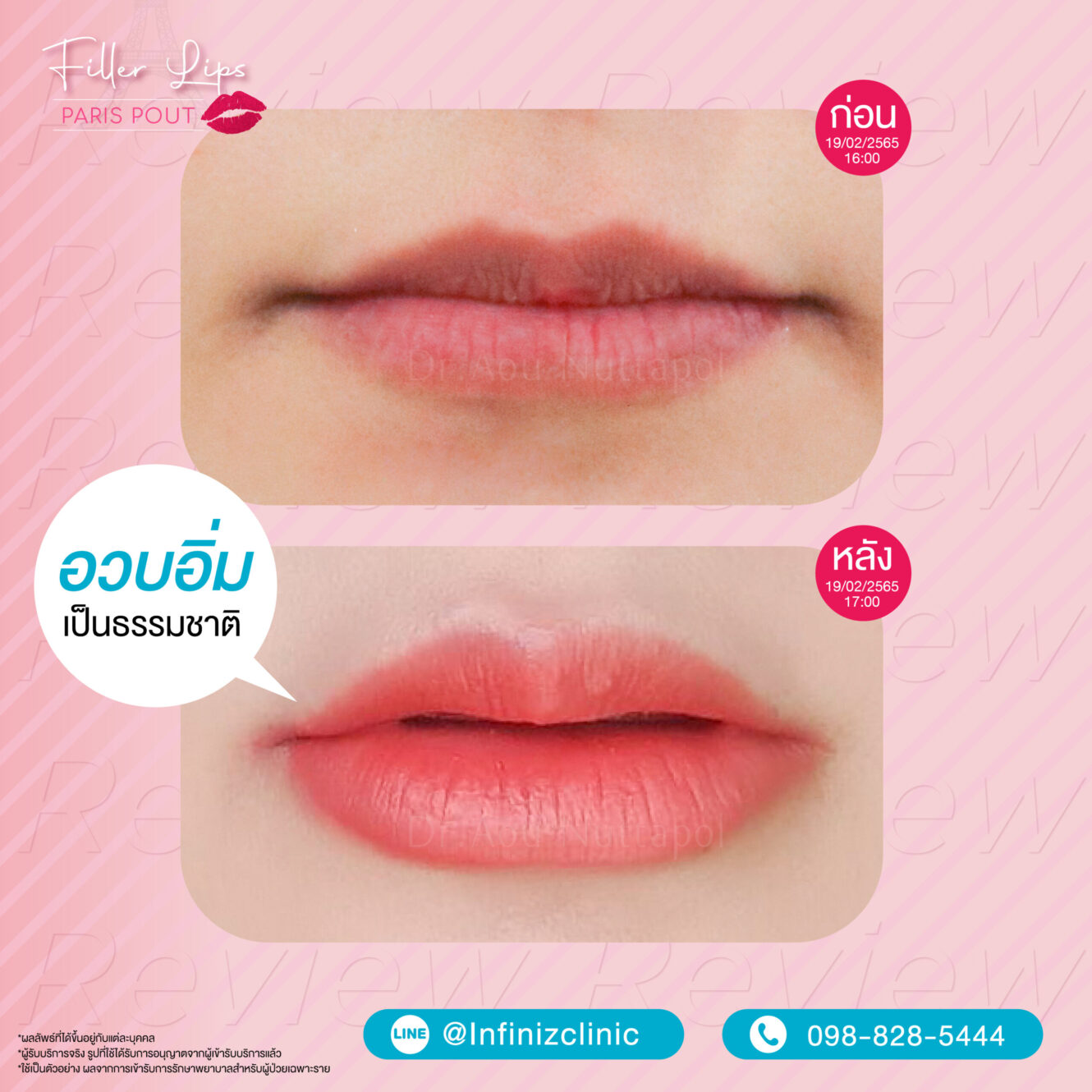 โปรแกรมฉีดฟิลเลอร์ปากบวมกี่วัน? ไขข้อสงสัยเกี่ยวกับอาการบวมหลังฉีดโปรแกรมฟิลเลอร์ปาก 2 BA kysse 05