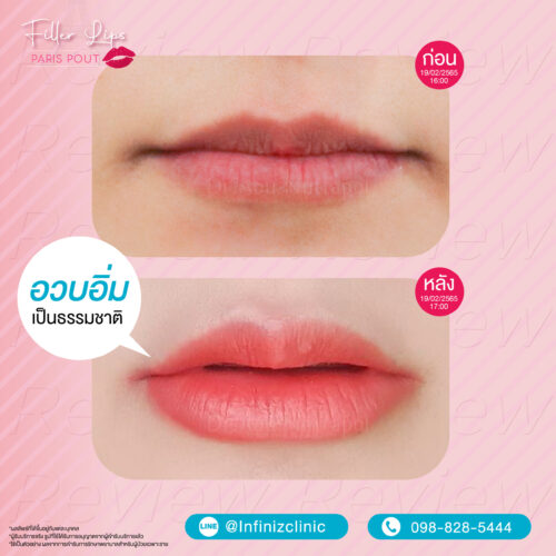 โปรแกรมฟิลเลอร์ Restylane ดีไหม ของแท้ดูอย่างไร ราคาเท่าไหร่บ้าง และข้อควรรู้ก่อนฉีด 9 BA kysse 05