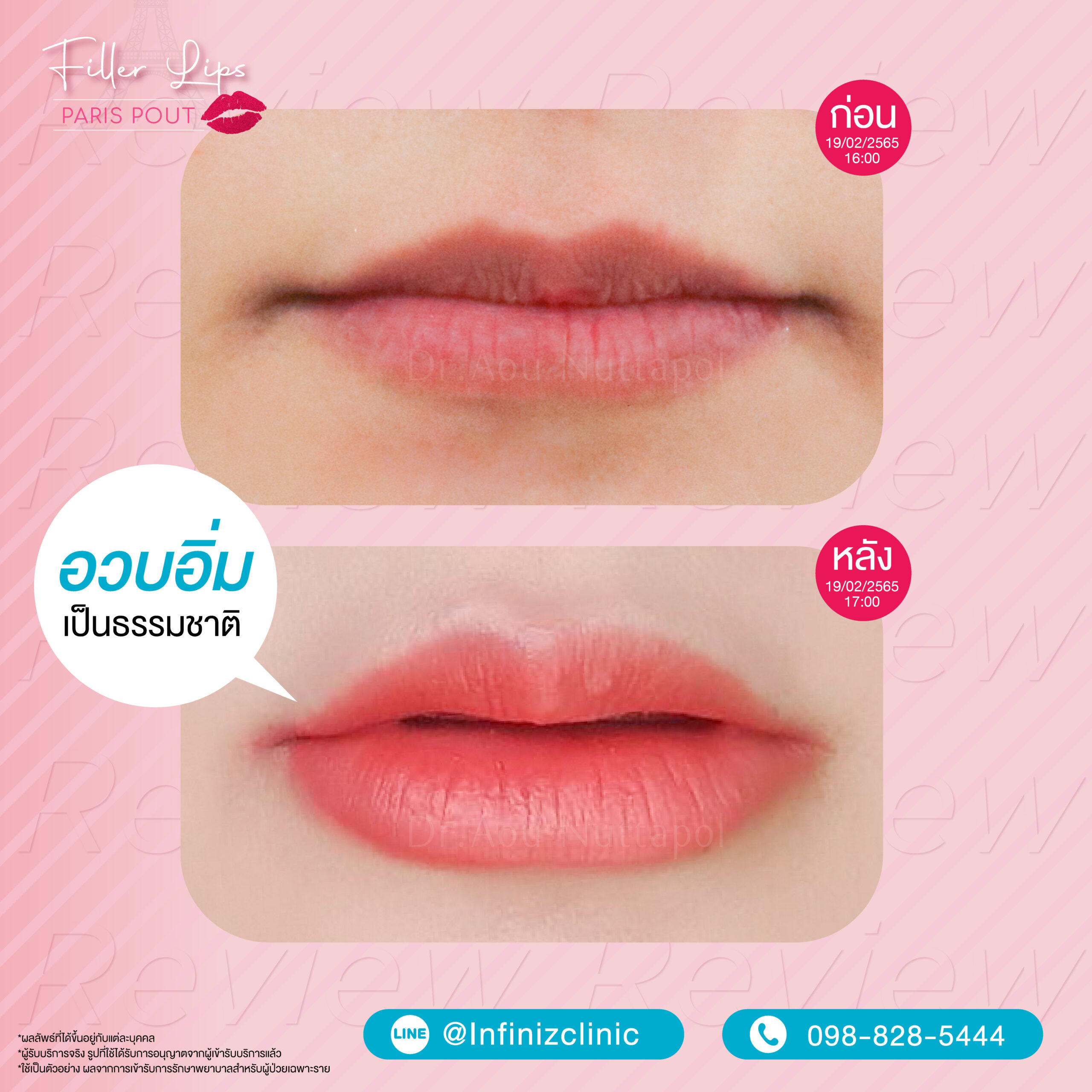 โปรแกรมฉีดฟิลเลอร์ปาก ยี่ห้อไหนดีที่ ? รวมเรื่องควรรู้ก่อนเติมโปรแกรมฟิลเลอร์ 2 BA kysse 05