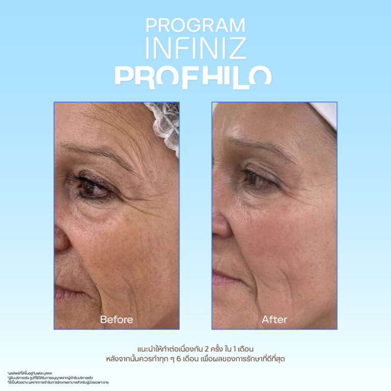 โปรแกรมProfhilo ปรับโรงสร้างผิวคืออะไร? ช่วยผิวหน้าใสได้อย่างไร? 8 Profhilo sale kit 06