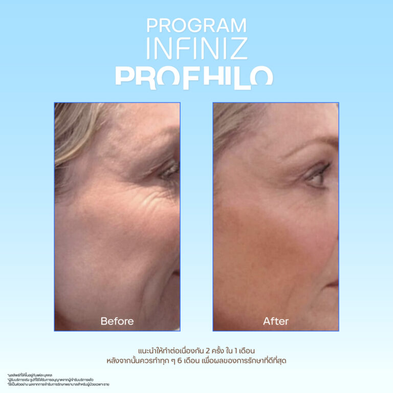โปรแกรมProfhilo ปรับโรงสร้างผิวคืออะไร? ช่วยผิวหน้าใสได้อย่างไร? 5 Profhilo sale kit 08