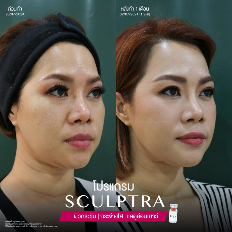โปรแกรม Sculptra ช่วยฟื้นฟูผิวเสียให้กลายเป็นผิวสวย 3 BA Sculptra 05