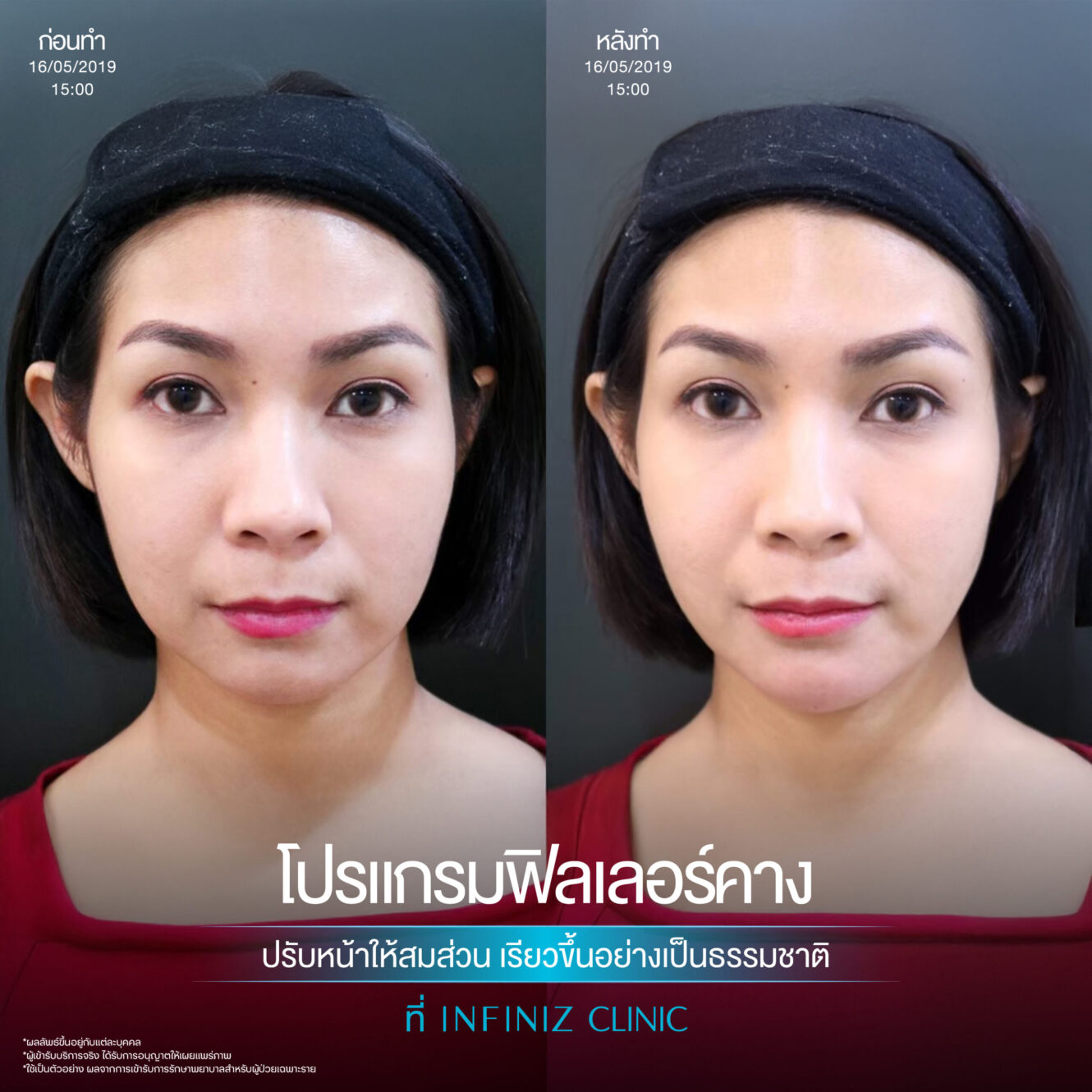 ฉีดฟิลเลอร์คางครั้งแรกต้องรู้อะไรบ้าง อันตรายไหม ราคาเท่าไหร่ 6 Filler คาง 01