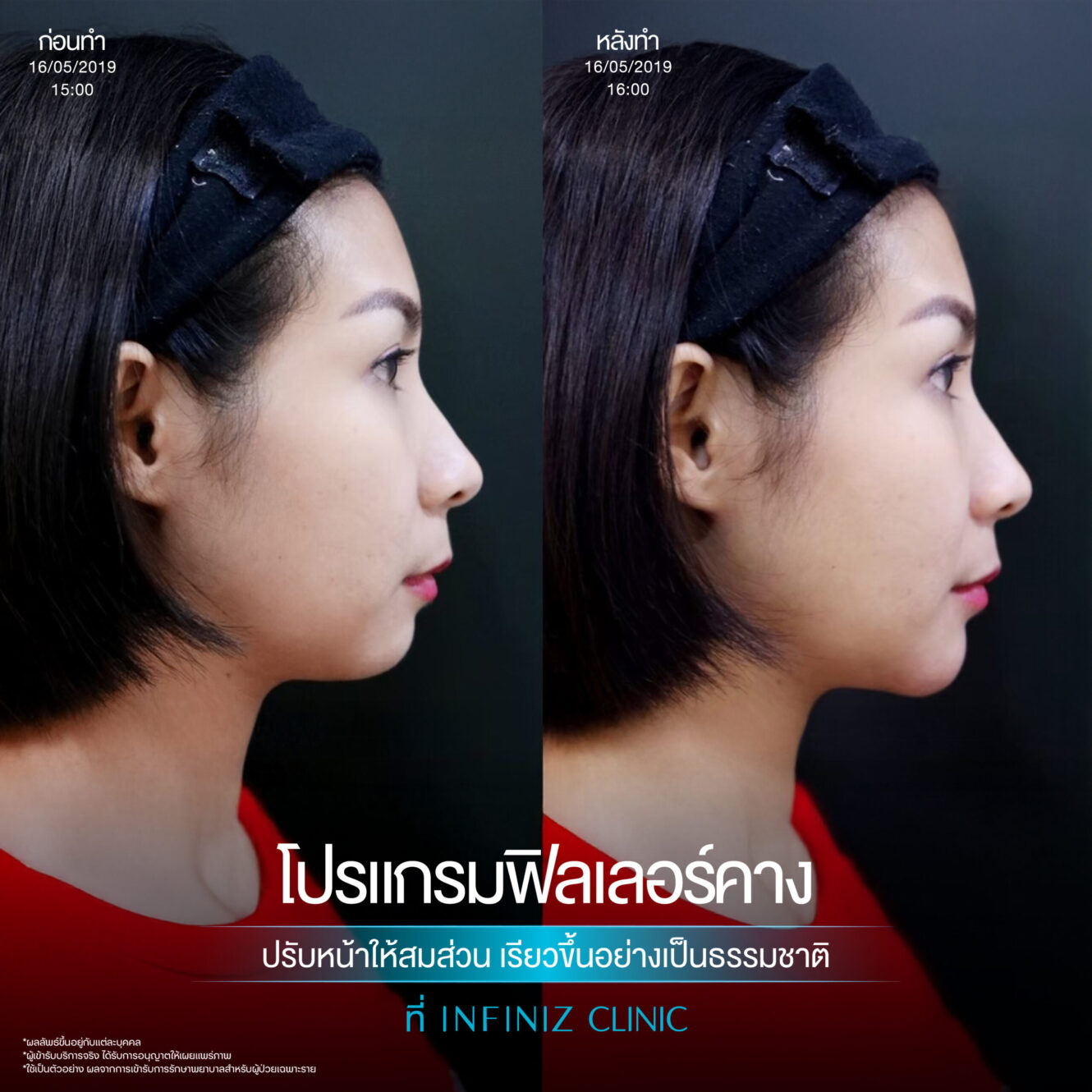 ฉีดฟิลเลอร์คางครั้งแรกต้องรู้อะไรบ้าง อันตรายไหม ราคาเท่าไหร่ 9 Filler คาง 02