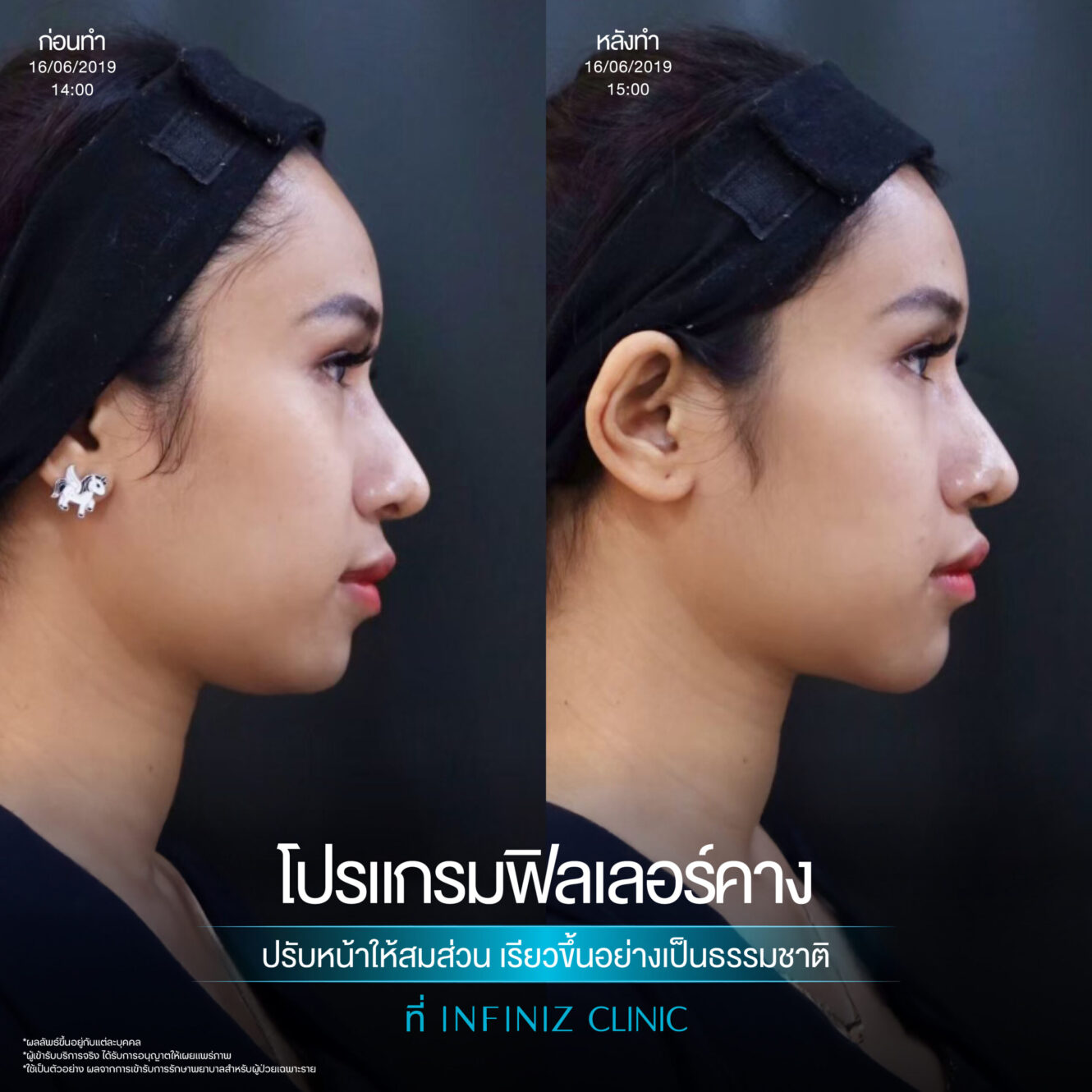 ฉีดฟิลเลอร์คางครั้งแรกต้องรู้อะไรบ้าง อันตรายไหม ราคาเท่าไหร่ 10 Filler คาง 03