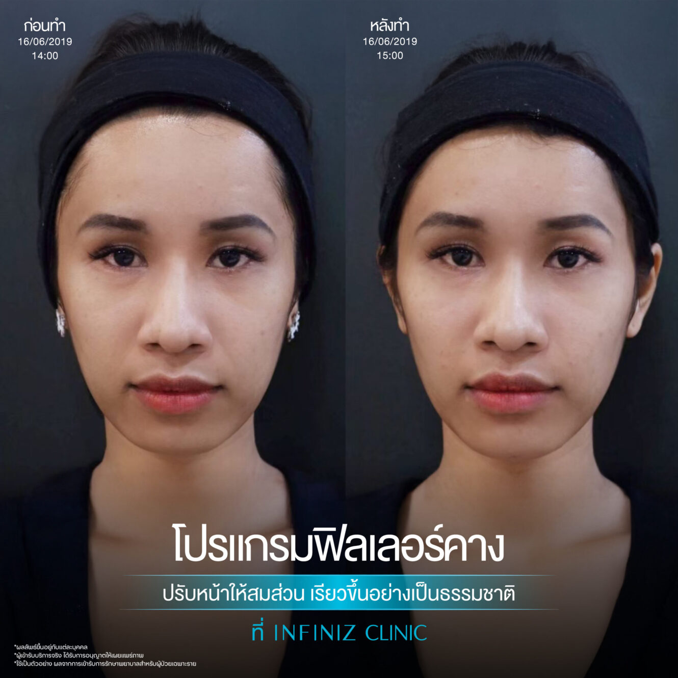 ฉีดฟิลเลอร์คางครั้งแรกต้องรู้อะไรบ้าง อันตรายไหม ราคาเท่าไหร่ 7 Filler คาง 04