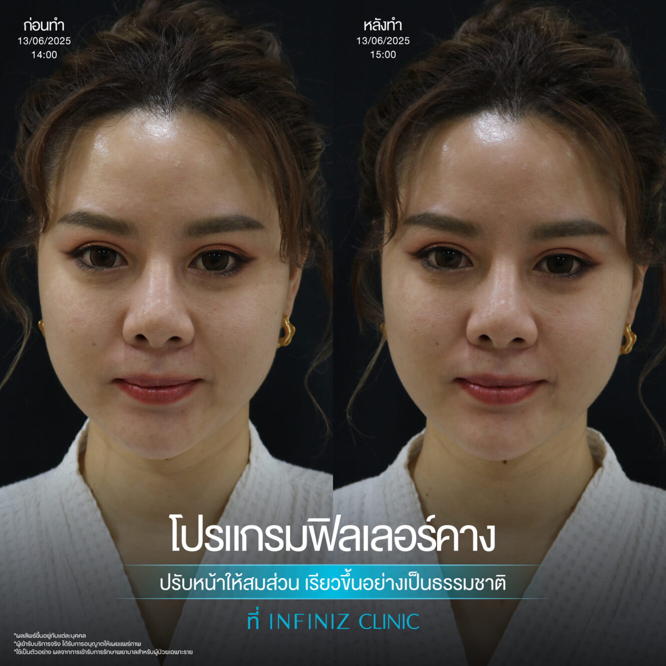 ฉีดฟิลเลอร์คางครั้งแรกต้องรู้อะไรบ้าง อันตรายไหม ราคาเท่าไหร่ 8 Filler คาง 05