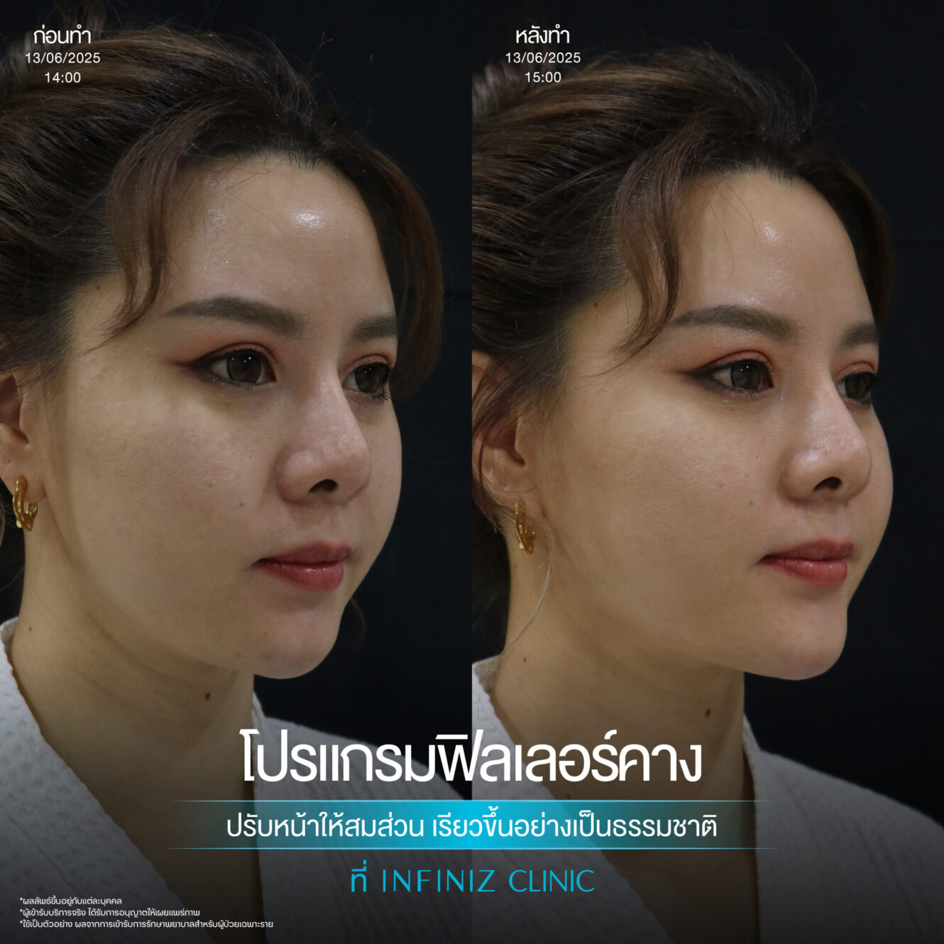 ฉีดฟิลเลอร์คางครั้งแรกต้องรู้อะไรบ้าง อันตรายไหม ราคาเท่าไหร่ 11 Filler คาง 06