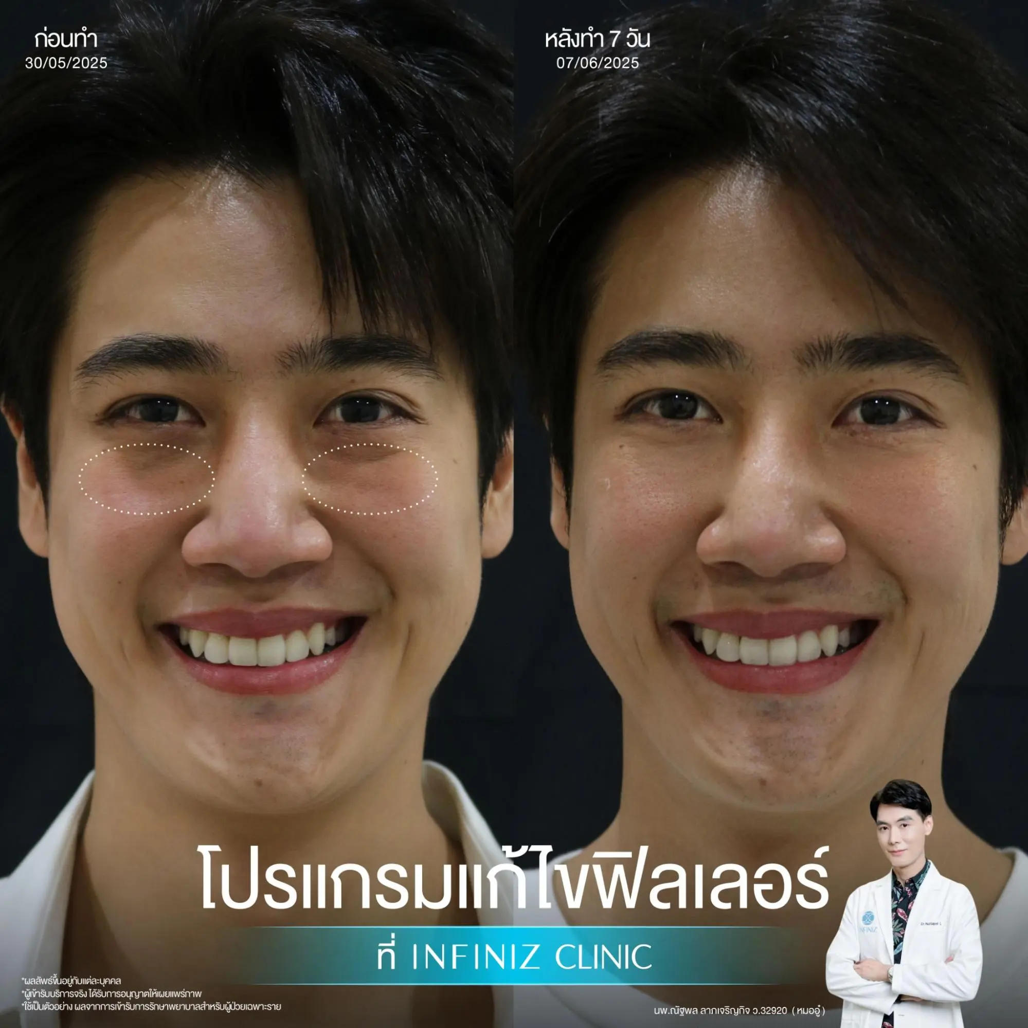 โปรแกรมสลายฟิลเลอร์คืออะไร? อันตรายหรือเปล่า? มีผลข้างเคียงอะไรไหม? 3 โปรแกรมสลายฟิลเลอร์อันตรายไหม