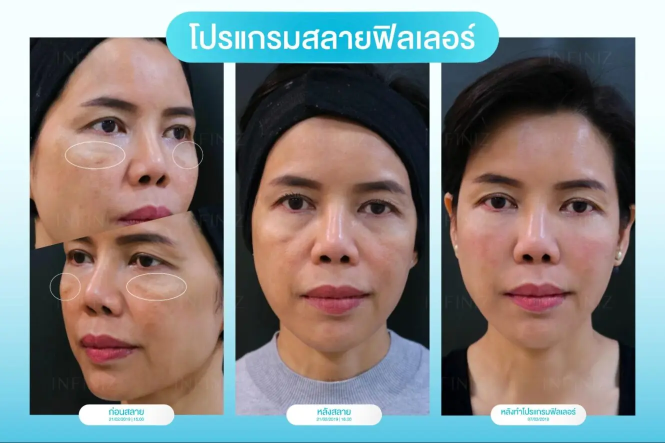 โปรแกรมฟิลเลอร์เป็นก้อนเกิดจากอะไร? แก้ได้ไหม หรือควรรีบพบแพทย์ 5 รักษาฟิลเลอร์เป็นก้อน