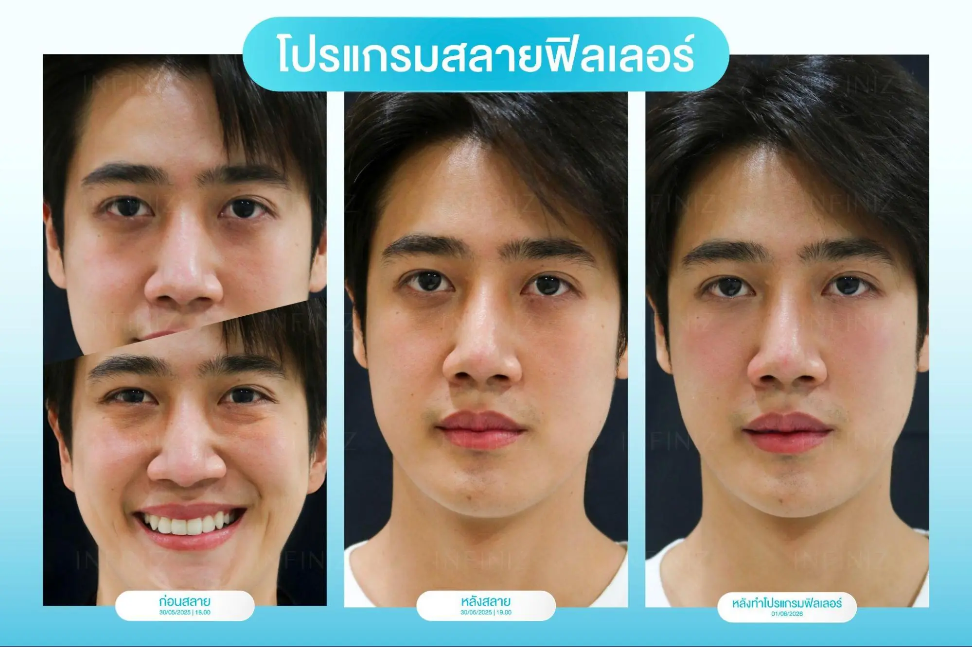 โปรแกรมสลายฟิลเลอร์กี่วันหาย? กู้หน้าเป็นก้อนนานแค่ไหน ให้กลับมั่นใจได้เหมือนเดิม 4 โปรแกรมฟิลเลอร์