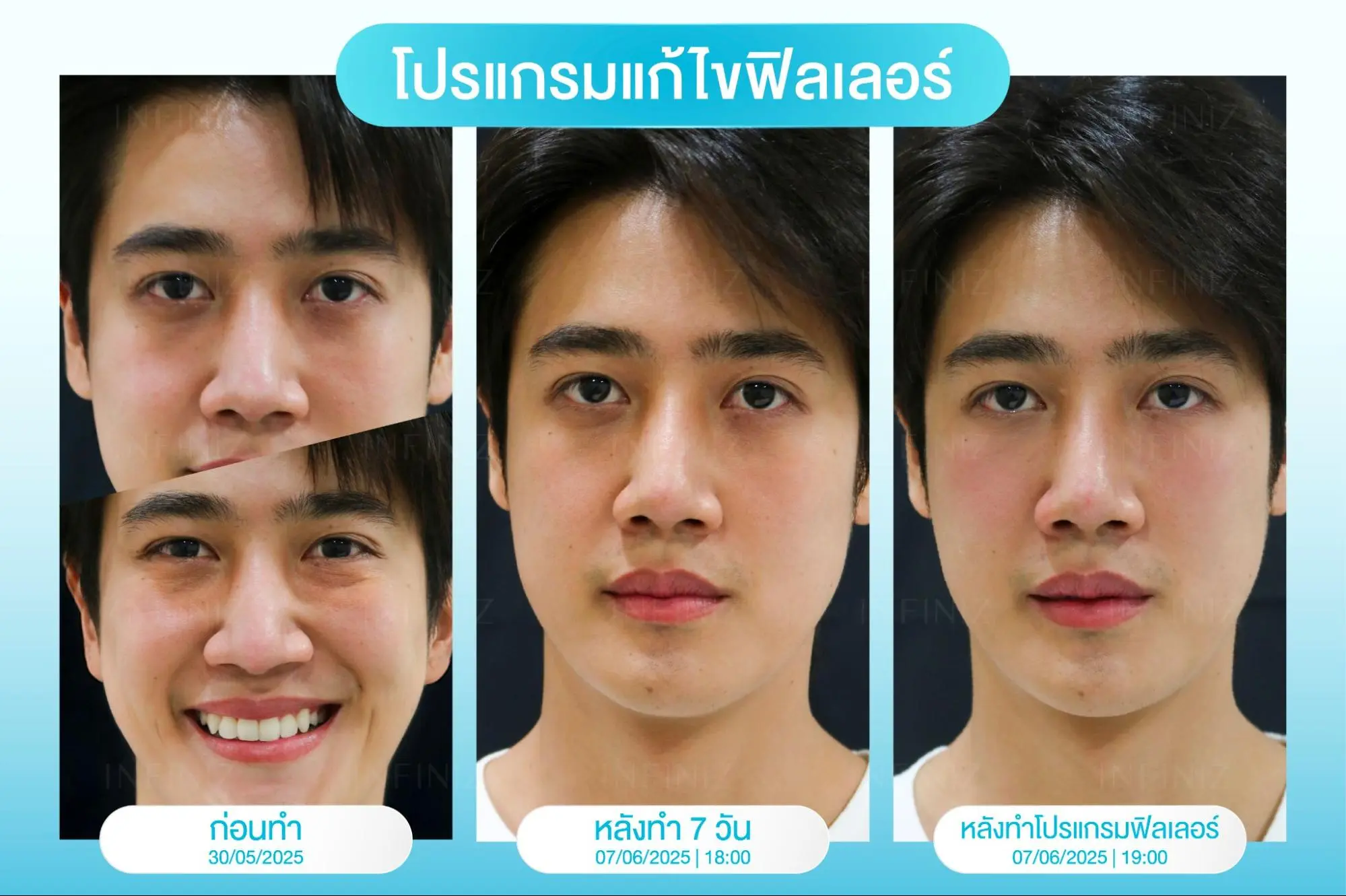 สลายโปรแกรมฟิลเลอร์ใต้ตาคืออะไร? ทำแล้วเป็นก้อน บวม ไม่เรียบเนียนแก้ได้จริงไหม 4 ทำโปรแกรมสลายฟิลเลอร์ใต้ตาแล้วต้องรอกี่วัน ถึงจะเห็นว่าเข้าที่?