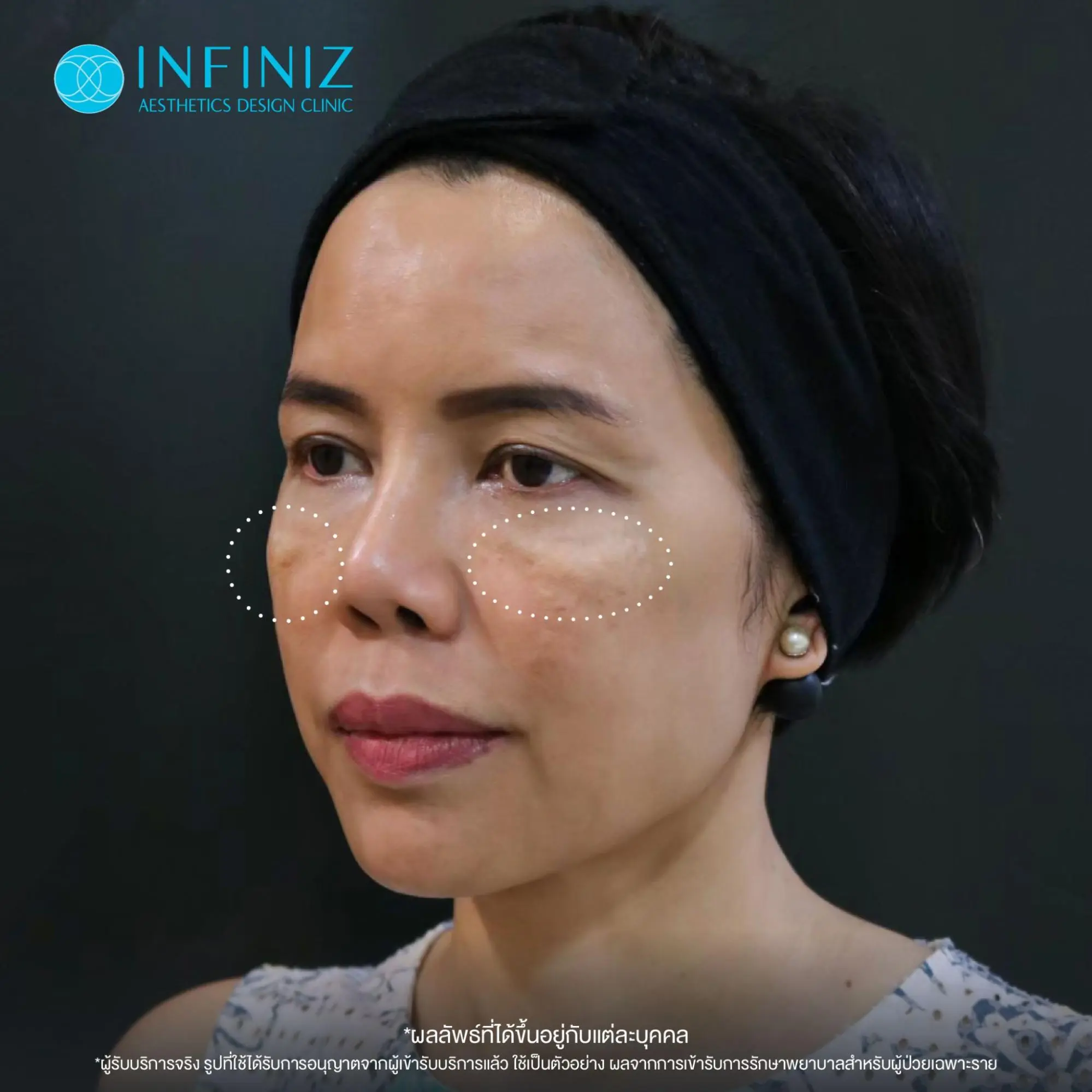 สลายโปรแกรมฟิลเลอร์ใต้ตาคืออะไร? ทำแล้วเป็นก้อน บวม ไม่เรียบเนียนแก้ได้จริงไหม 2 โปรแกรมสลายฟิลเลอร์ใต้ตาคืออะไร