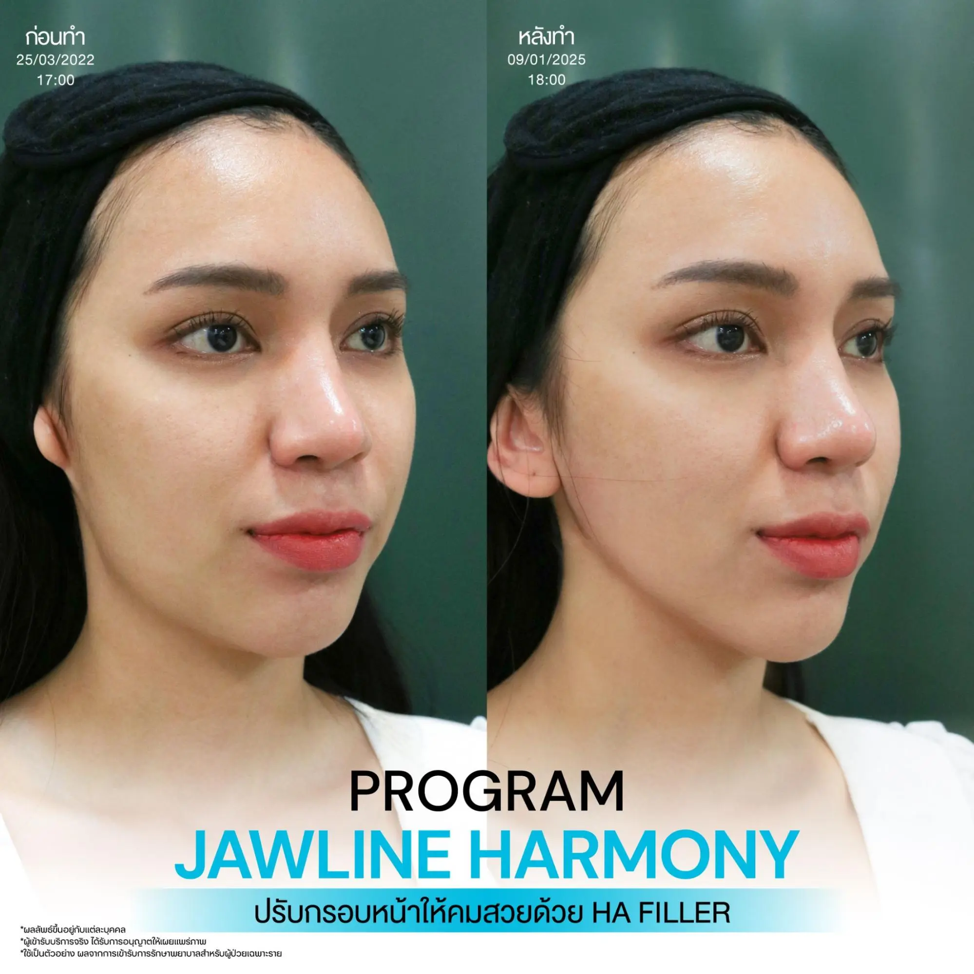 10 วิธียกกระชับหน้า เมื่อแก้มเริ่มหย่อน กรอบหน้าเริ่มหาย วิธีไหนตอบโจทย์คุณ? 6 ยกกระชับผิวด้วยโปรแกรมฟิลเลอร์