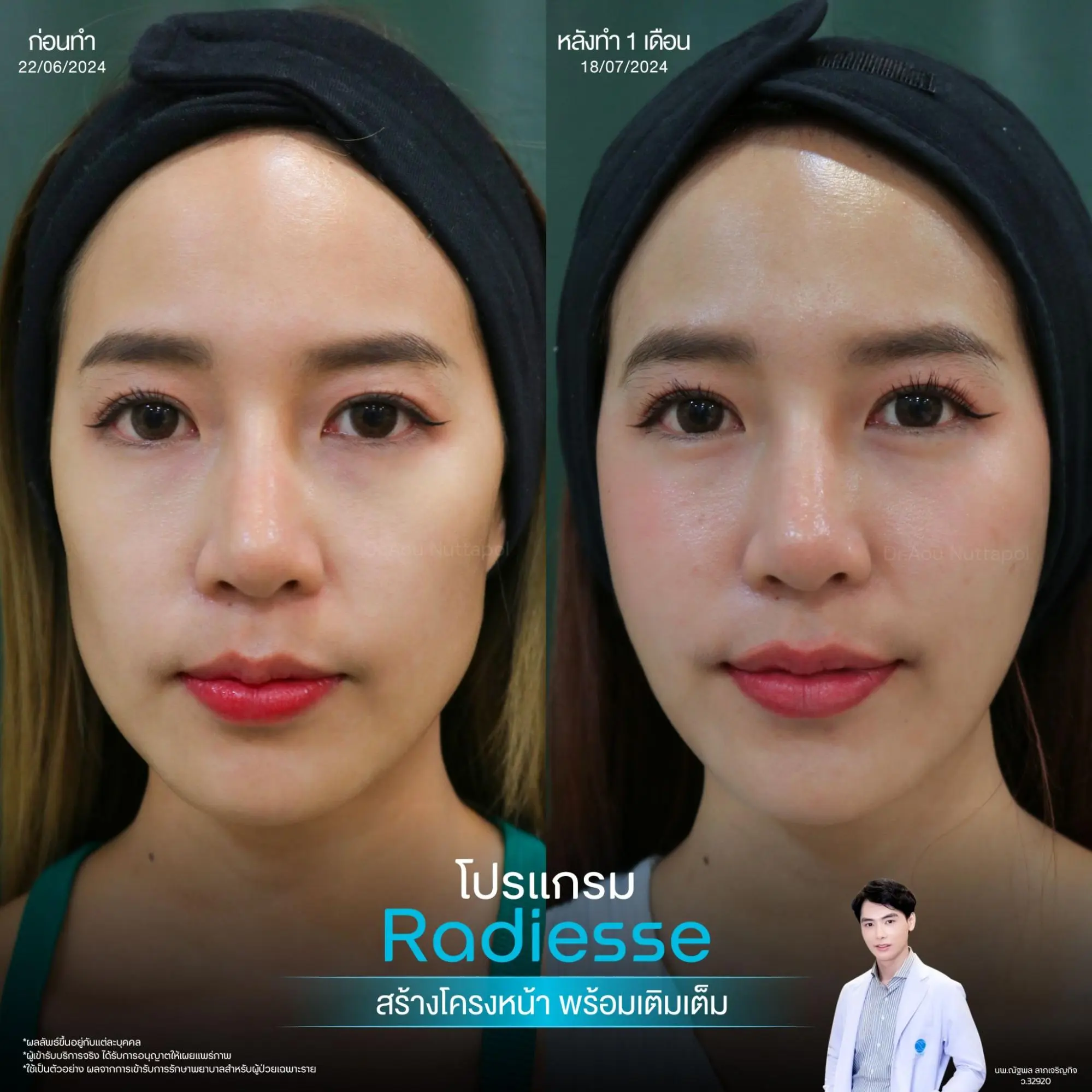 10 วิธียกกระชับหน้า เมื่อแก้มเริ่มหย่อน กรอบหน้าเริ่มหาย วิธีไหนตอบโจทย์คุณ? 7 ยกกระชับผิวด้วย Radiesse