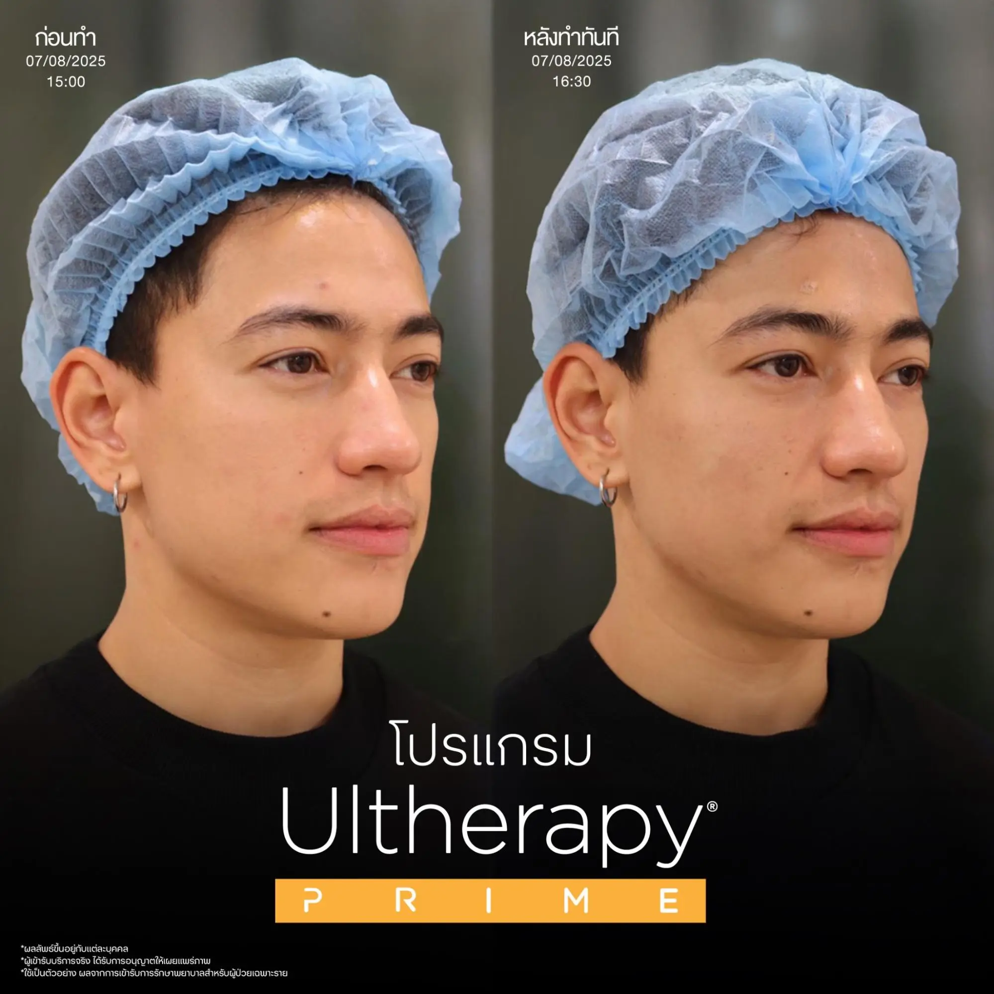 10 วิธียกกระชับหน้า เมื่อแก้มเริ่มหย่อน กรอบหน้าเริ่มหาย วิธีไหนตอบโจทย์คุณ? 3 ยกกระชับผิวด้วย Ulthera