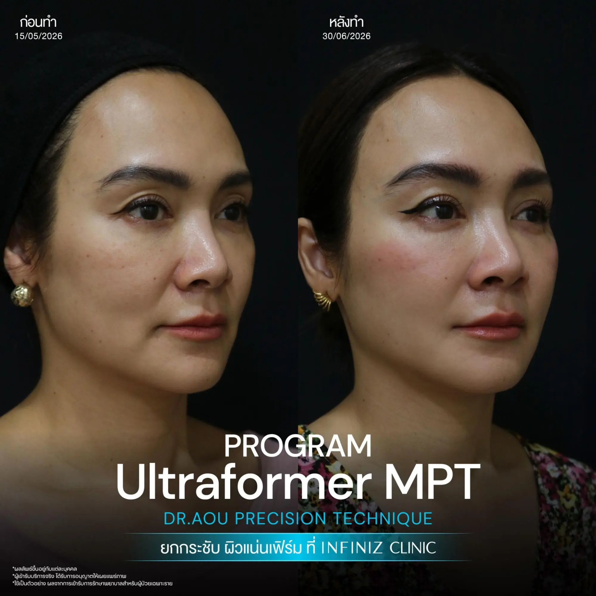 10 วิธียกกระชับหน้า เมื่อแก้มเริ่มหย่อน กรอบหน้าเริ่มหาย วิธีไหนตอบโจทย์คุณ? 5 ยกกระชับผิวด้วย Ultraformer