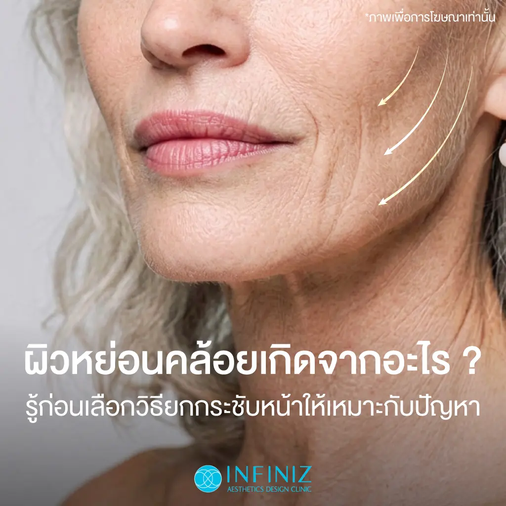 10 วิธียกกระชับหน้า เมื่อแก้มเริ่มหย่อน กรอบหน้าเริ่มหาย วิธีไหนตอบโจทย์คุณ? 2 ยกกระชับผิวUlthera